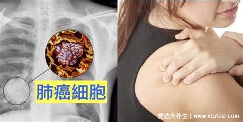 癌症前期的18种预兆和图片,常见的乳腺癌/胃癌/肝癌症状合集