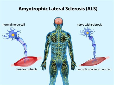 als的临床表现(als患者的早期症状)